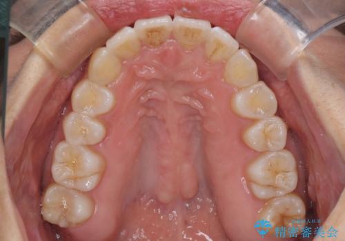 インビザラインで機能面に問題のある歯列を改善の治療後