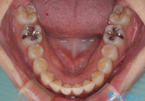 インビザラインで機能面に問題のある歯列を改善の治療後