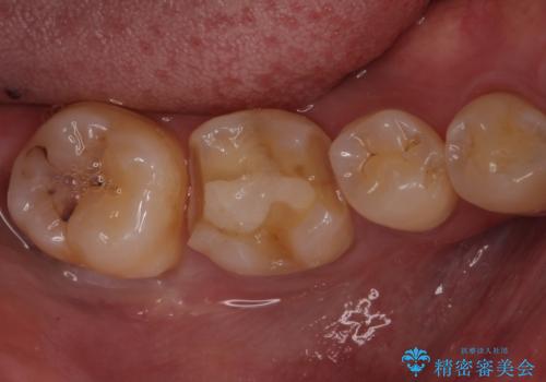 セラミックインレーやりかえ 虫歯の除去をしっかりとの治療中