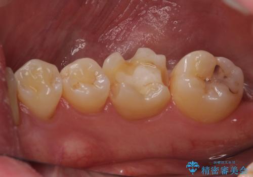 セラミックインレーやりかえ 虫歯の除去をしっかりとの治療中