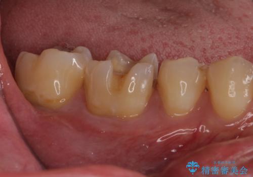 セラミックインレーやりかえ 虫歯の除去をしっかりとの治療中