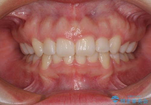 目立たない裏側矯正 抜歯矯正で口元を改善の症例 治療後