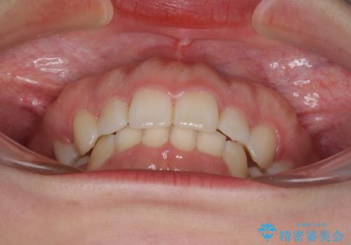 目立たない裏側矯正 抜歯矯正で口元を改善の治療後