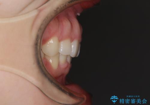 目立たない裏側矯正　抜歯矯正で口元を改善の治療後