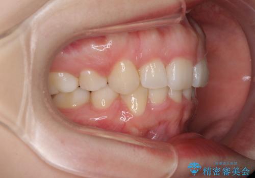 目立たない裏側矯正 抜歯矯正で口元を改善の治療後
