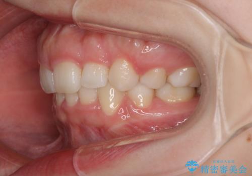 目立たない裏側矯正 抜歯矯正で口元を改善の治療後