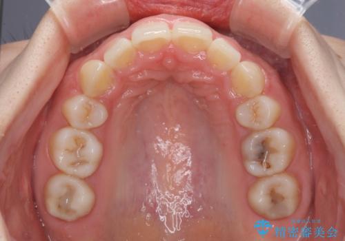 目立たない裏側矯正 抜歯矯正で口元を改善の治療後