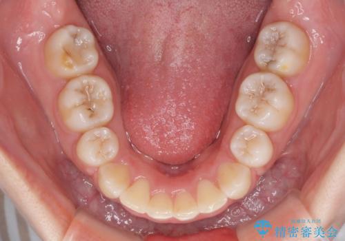 目立たない裏側矯正 抜歯矯正で口元を改善の治療後