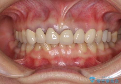 深い虫歯と不自然な色調の前歯 オールセラミッククラウンで自然にの治療前