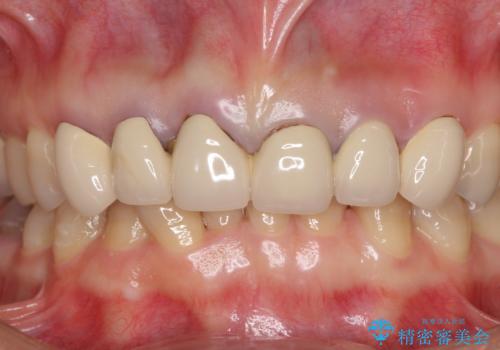深い虫歯と不自然な色調の前歯　オールセラミッククラウンで自然にの治療前