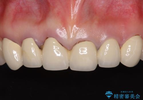 深い虫歯と不自然な色調の前歯　オールセラミッククラウンで自然にの症例 治療前