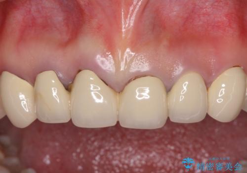 深い虫歯と不自然な色調の前歯　オールセラミッククラウンで自然にの治療前