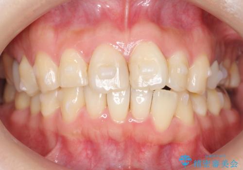 前歯の歯並びが気になる マウスピース矯正 30代女性の治療中