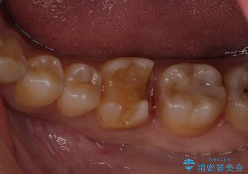 適合不良の銀のつめもの 保険と自費で白くの治療中