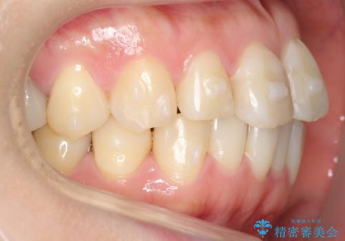 前歯の歯並びが気になる マウスピース矯正 30代女性の治療中