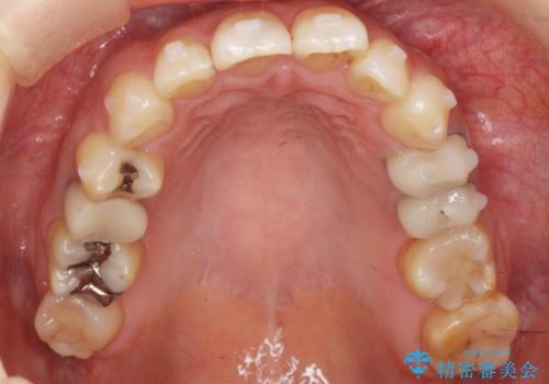 前歯の歯並びが気になる マウスピース矯正 30代女性の治療中