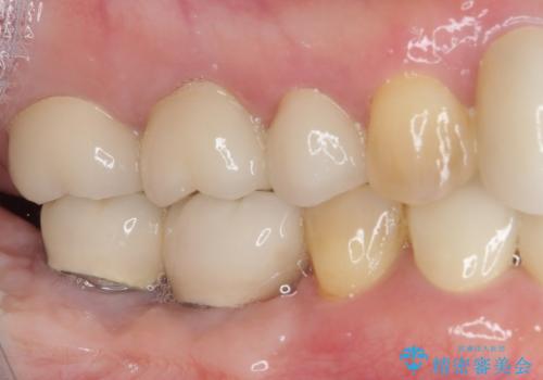 磨きにくい奥歯のインプラント周り 歯肉移植(FGG)による角化歯肉の獲得 の治療後