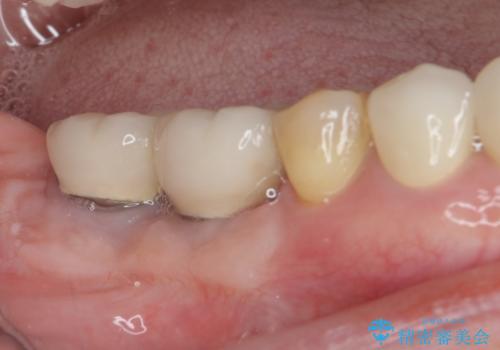 磨きにくい奥歯のインプラント周り　歯肉移植(FGG)による角化歯肉の獲得　の治療後