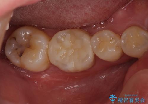 セラミックインレーやりかえ　虫歯の除去をしっかりとの症例 治療後