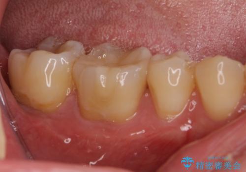 セラミックインレーやりかえ 虫歯の除去をしっかりとの治療後