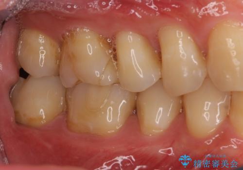 セラミックインレーやりかえ 虫歯の除去をしっかりとの治療後