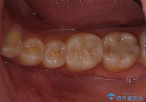適合不良の銀のつめもの　保険と自費で白くの治療後