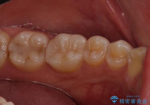 適合不良の銀のつめもの 保険と自費で白くの治療後