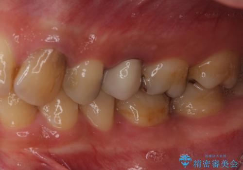 適合不良の銀のつめもの 保険と自費で白くの治療後