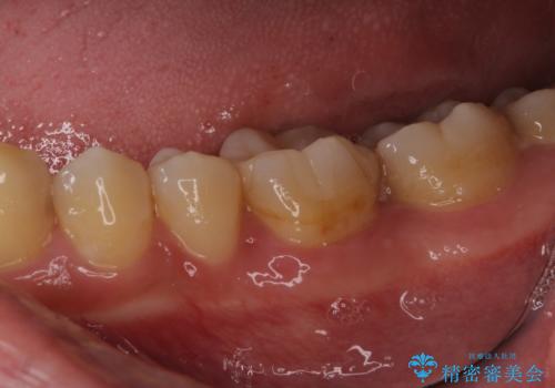 適合不良の銀のつめもの 保険と自費で白くの治療後