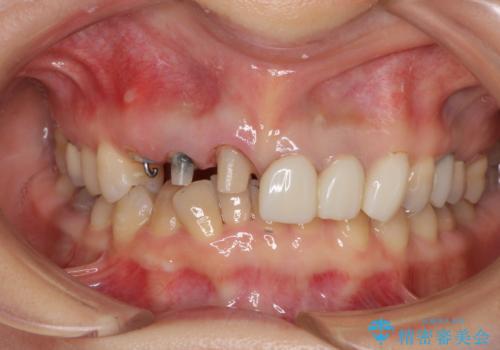 深い虫歯と不自然な色調の前歯　オールセラミッククラウンで自然にの治療中