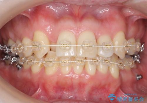 40代の矯正 八重歯を綺麗に の治療中