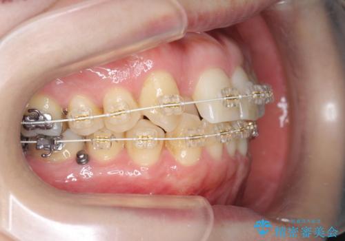 40代の矯正 八重歯を綺麗に の治療中