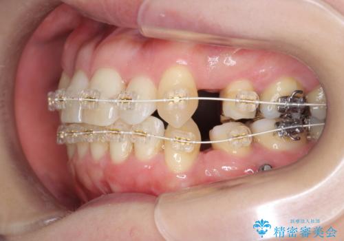 40代の矯正 八重歯を綺麗に の治療中