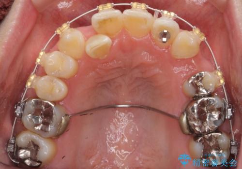 40代の矯正 八重歯を綺麗に の治療中