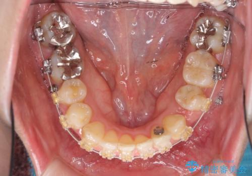 40代の矯正 八重歯を綺麗に の治療中