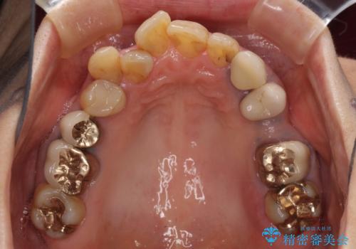 ノンクラスプデンチャー(金属止め具のない入れ歯)で左側の咬合回復の治療前