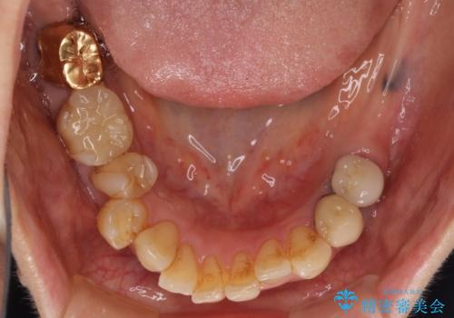 ノンクラスプデンチャー(金属止め具のない入れ歯)で左側の咬合回復の治療前
