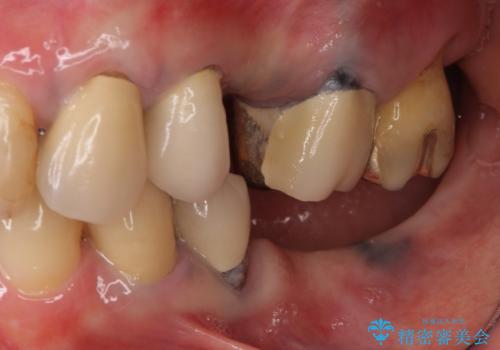 ノンクラスプデンチャー(金属止め具のない入れ歯)で左側の咬合回復の治療前