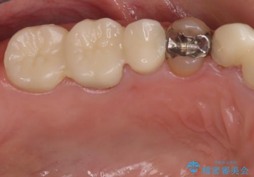 磨きにくい奥歯のインプラント周り 歯肉移植(FGG)による角化歯肉の獲得 の治療前