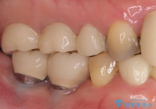 磨きにくい奥歯のインプラント周り　歯肉移植(FGG)による角化歯肉の獲得　の治療前
