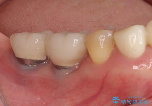 磨きにくい奥歯のインプラント周り　歯肉移植(FGG)による角化歯肉の獲得　の治療前