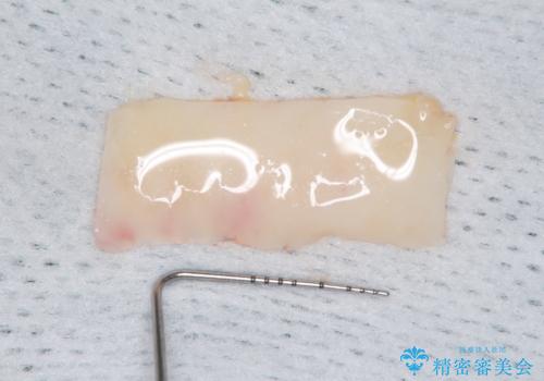 磨きにくい奥歯のインプラント周り　歯肉移植(FGG)による角化歯肉の獲得　の治療中