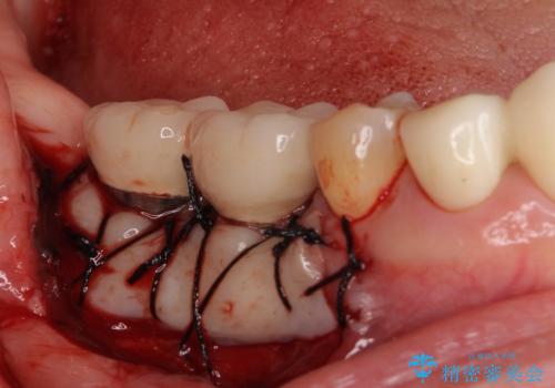 磨きにくい奥歯のインプラント周り　歯肉移植(FGG)による角化歯肉の獲得　の治療中