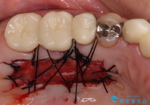 磨きにくい奥歯のインプラント周り 歯肉移植(FGG)による角化歯肉の獲得 の治療中