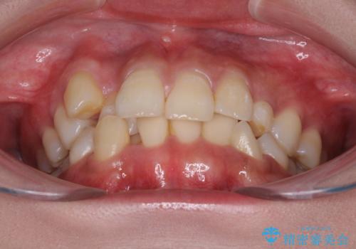 インビザライン矯正とインプラント治療と 総合歯科治療の治療前