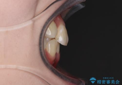 インビザライン矯正とインプラント治療と 総合歯科治療の治療前