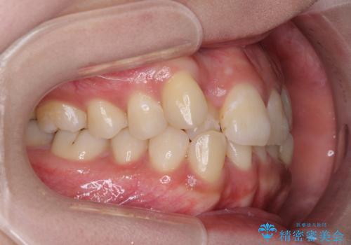 インビザライン矯正とインプラント治療と 総合歯科治療の治療前