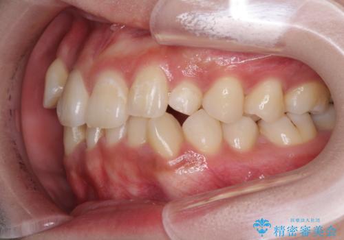 インビザライン矯正とインプラント治療と 総合歯科治療の治療前