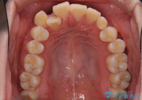 インビザライン矯正とインプラント治療と 総合歯科治療の治療前