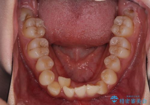 インビザライン矯正とインプラント治療と 総合歯科治療の治療前